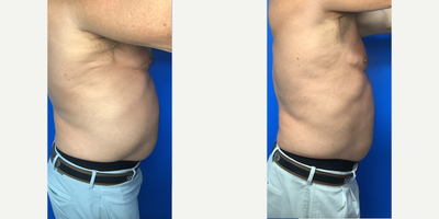 Emsculpt before and after photo