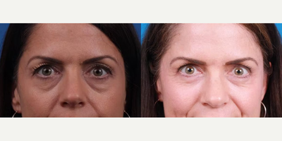 Laser Resurfacing before and after photo