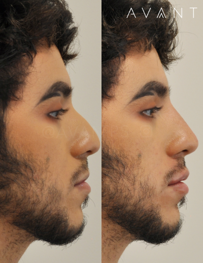Nonsurgical Nose Job before and after photo
