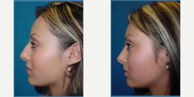 Rhinoplasty before and after photo