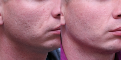 Bellafill before and after photo