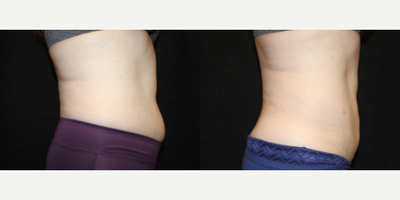 CoolSculpting before and after photo