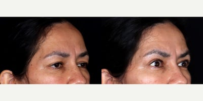 Eyelid Surgery before and after photo
