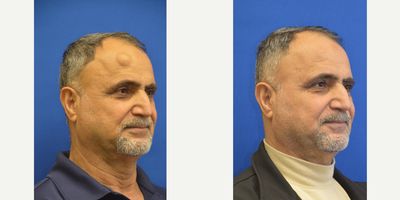 Lipoma Removal before and after photo
