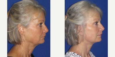 Mini Facelift before and after photo