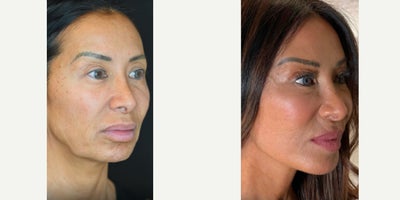 Neck Lift before and after photo