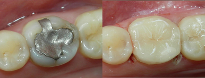 Tooth Repair before and after photo