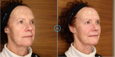 Thread Lift before and after photo