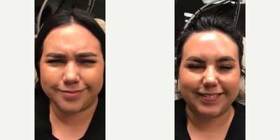 Botox before and after photo