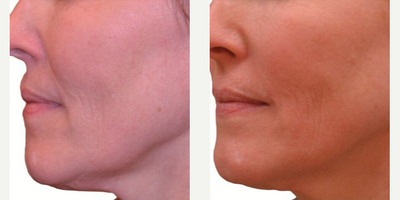 Venus Viva before and after photo