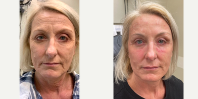 Botox before and after photo