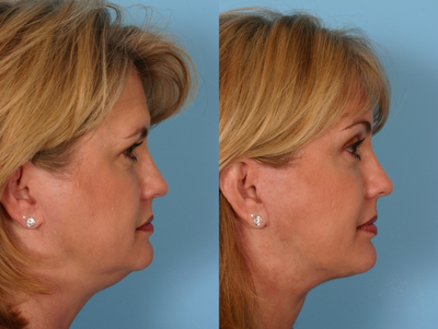 Brow Lift before and after photo