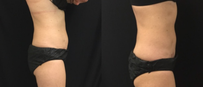 CoolSculpting before and after photo