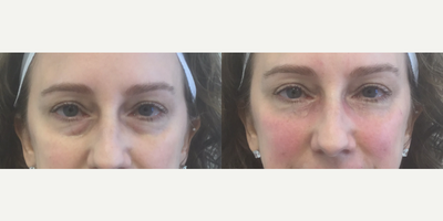 Eyelid Surgery before and after photo