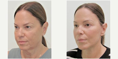 Lower Facelift before and after photo