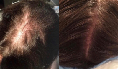 PRP for Hair Loss before and after photo