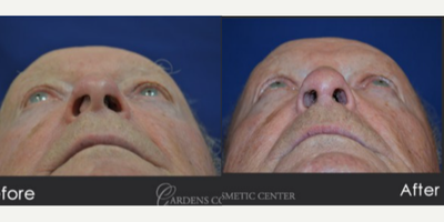 Rhinoplasty before and after photo