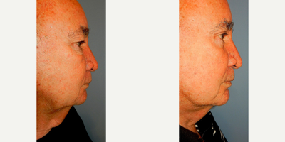 Eyelid Surgery before and after photo