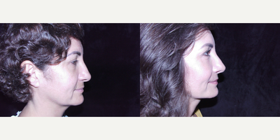 Rhinoplasty before and after photo