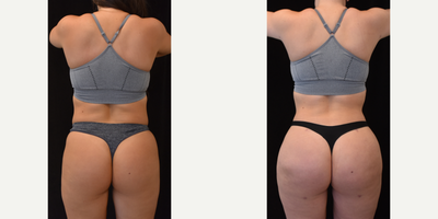 Brazilian Butt Lift before and after photo