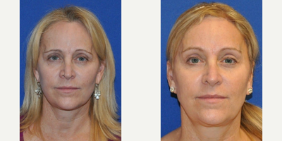 Brow Lift before and after photo