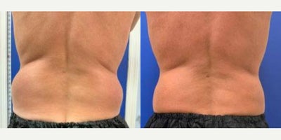 CoolSculpting before and after photo