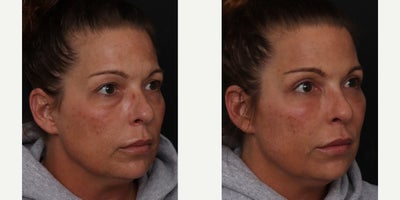 Eyelid Surgery before and after photo