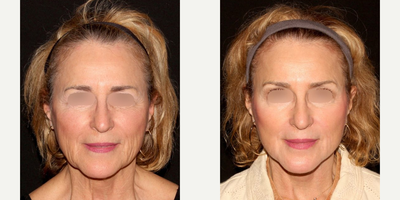 Facelift before and after photo