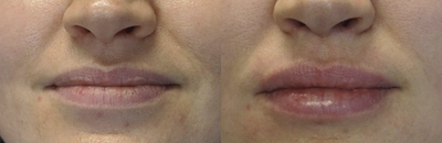 Juvederm before and after photo