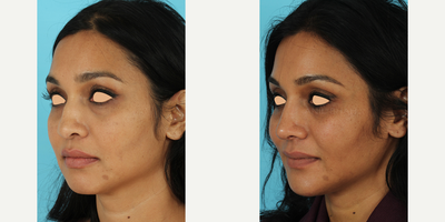 Revision Rhinoplasty before and after photo