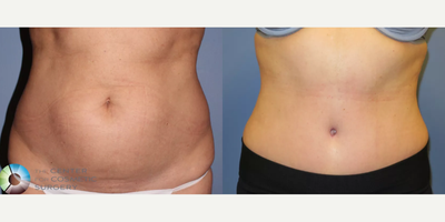 Tummy Tuck before and after photo