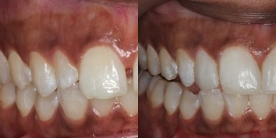 Dental Bonding before and after photo