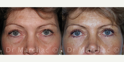 Eyelid Surgery before and after photo