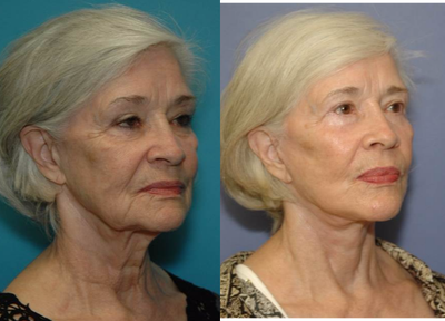 Facelift before and after photo