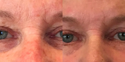 Botox before and after photo