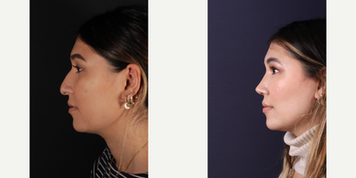 Buccal Fat Removal before and after photo