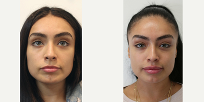 Dermal Fillers before and after photo