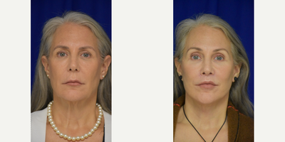Facelift before and after photo
