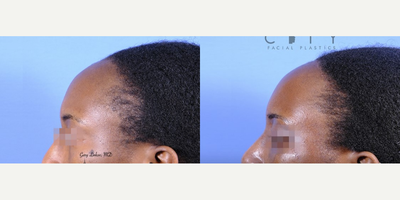 Forehead Reduction before and after photo
