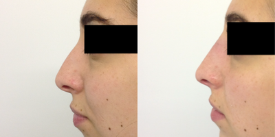 Nonsurgical Nose Job before and after photo