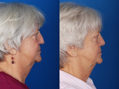 Revision Rhinoplasty before and after photo