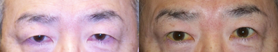 Double Eyelid Surgery before and after photo