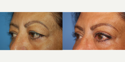 Eyelid Surgery before and after photo