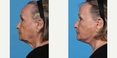 Facelift before and after photo