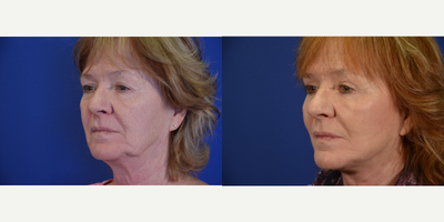 Facelift before and after photo