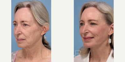 Facelift before and after photo