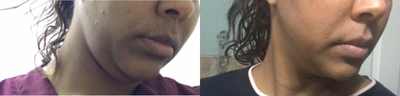 Kybella before and after photo