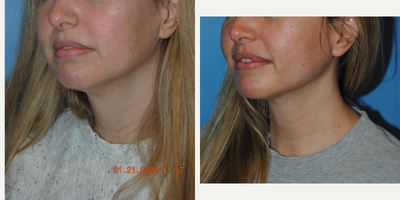 Liposuction before and after photo