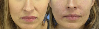 Bellafill before and after photo