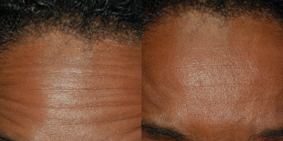 Botox before and after photo